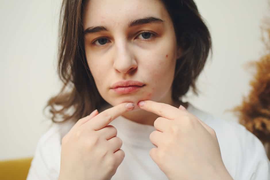 microneedling vs chemical peel for acne scars