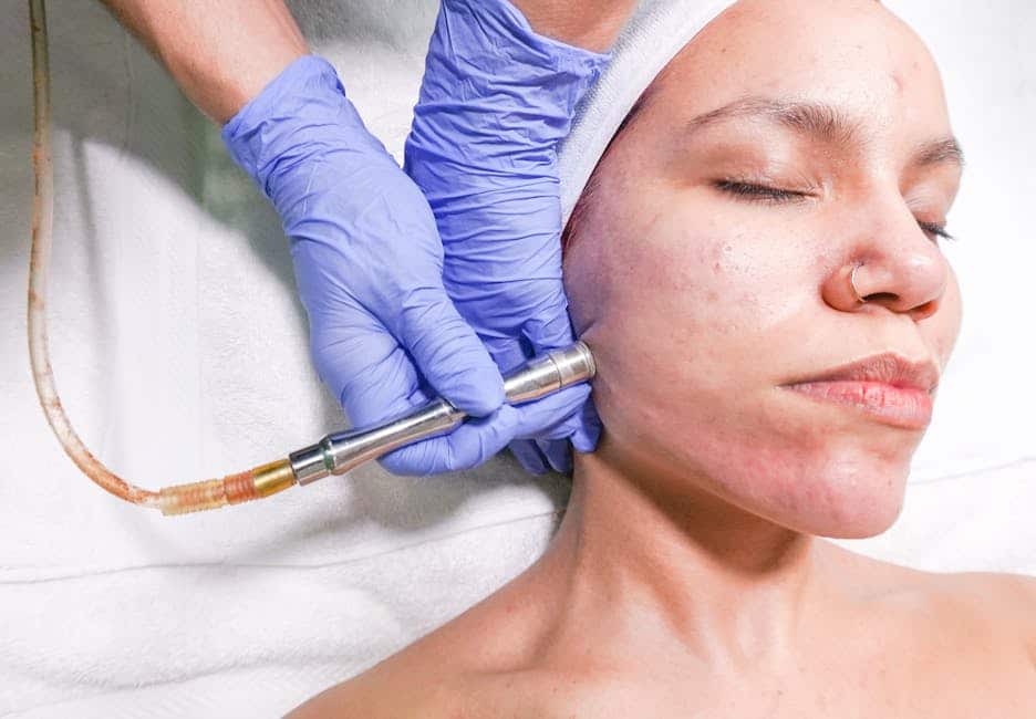Acne chemical peel