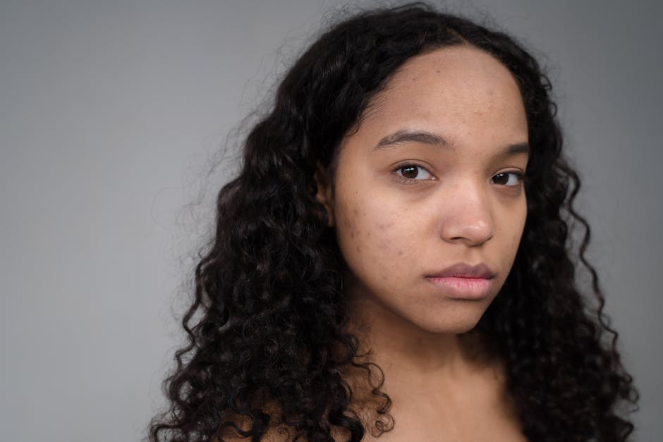 chemical peeling for acne scars