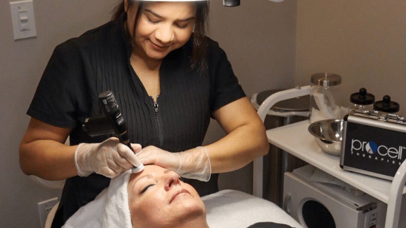 can a chemical peel help acne