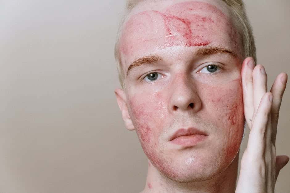 best acne peel treatment