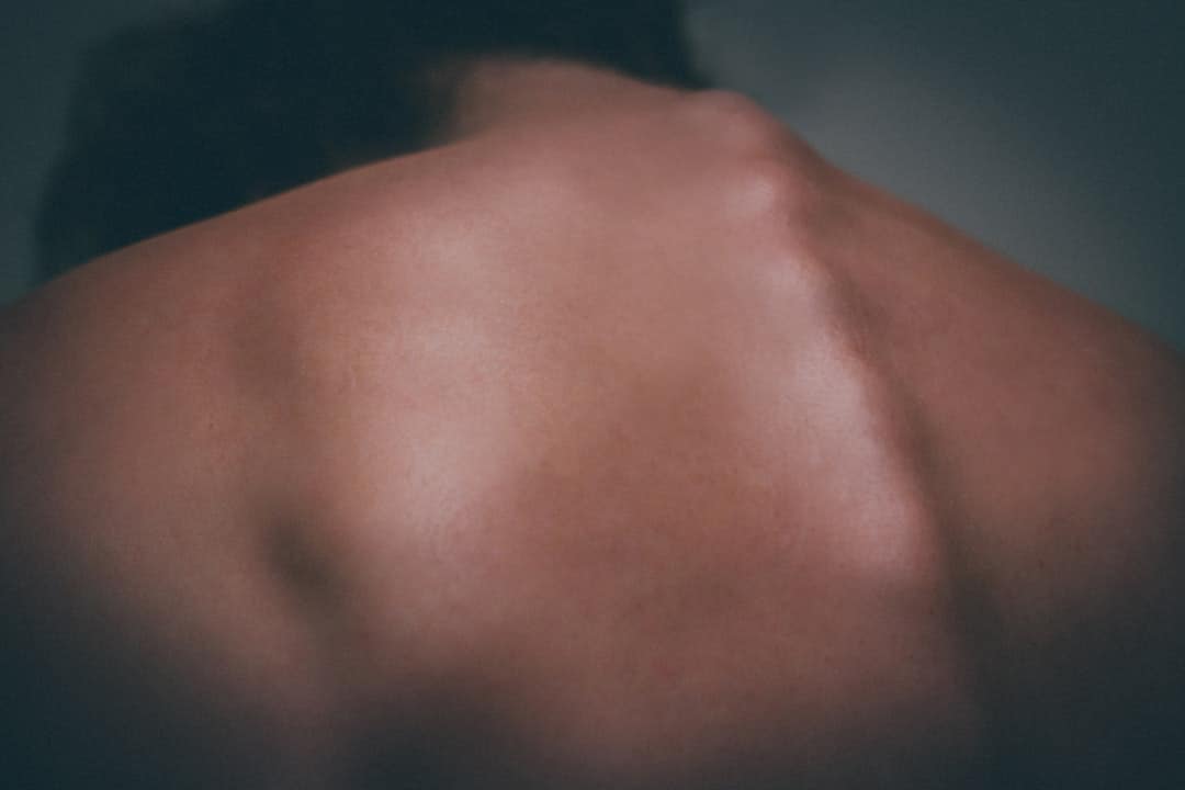 chemical peel on the back