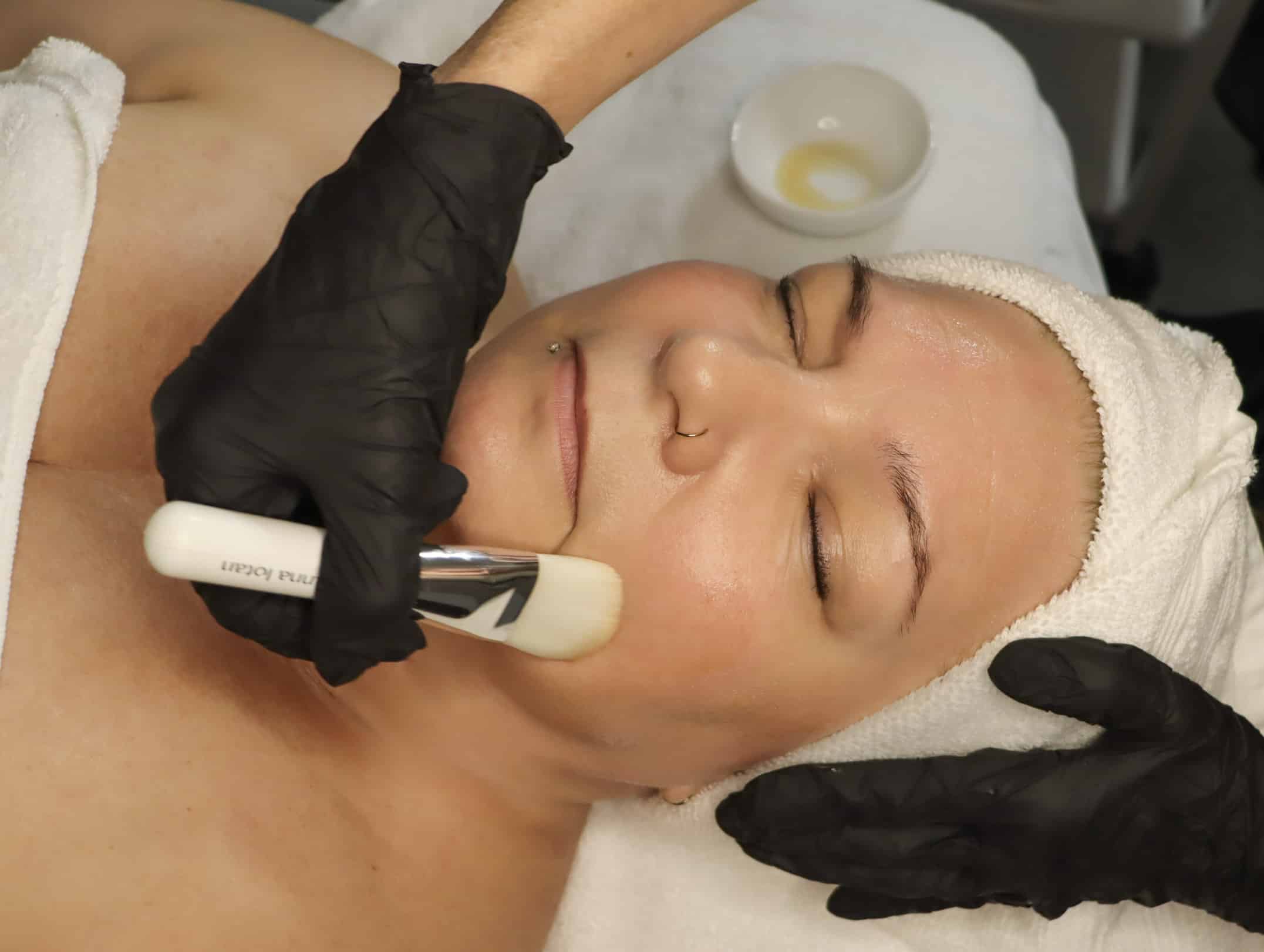 chemical peel image 01